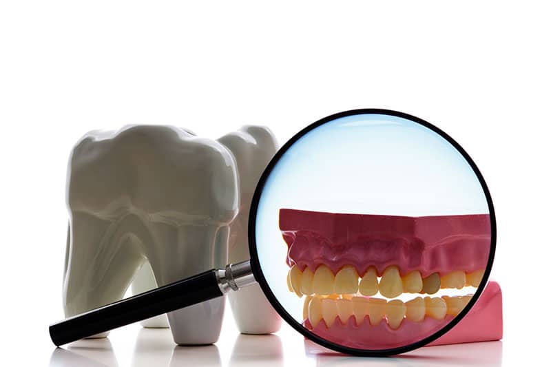 root canal