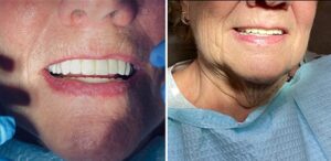 After Image: Implant Bridge