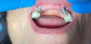 Before Image: Implant Bridge