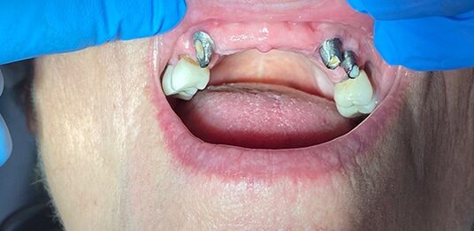 Before Image: Implant Bridge - front