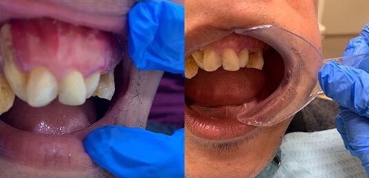 Before Image: Implant Dentures - front
