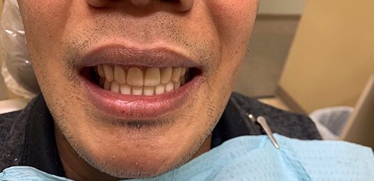 After Image: Implant Dentures - front
