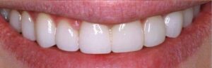 After Image: Implant Dentures