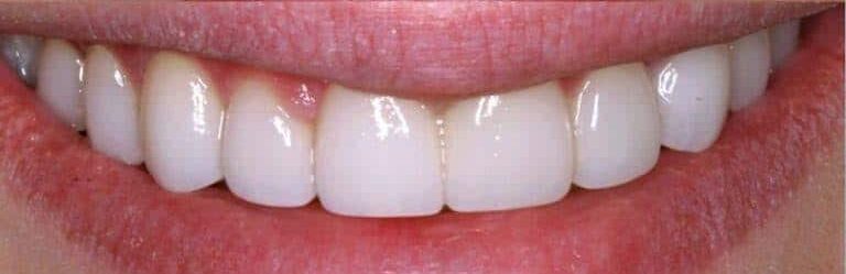 After Image: Implant Dentures - front