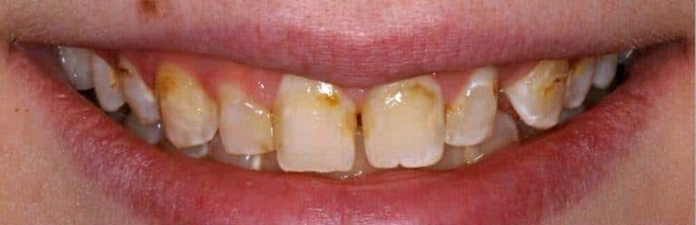 Before Image: Implant Dentures - front
