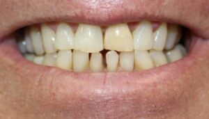 Before Image: Implant Dentures