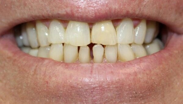 Before Image: Implant Dentures - front