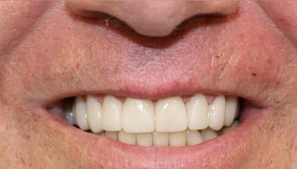 After Image: Implant Dentures - front