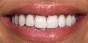 After Image: Implant Dentures - front