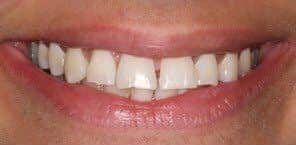 Before Image: Implant Dentures