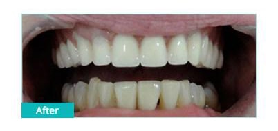 After Image: Implant Bridge - front
