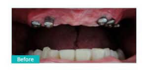 Before Image: Implant Bridge