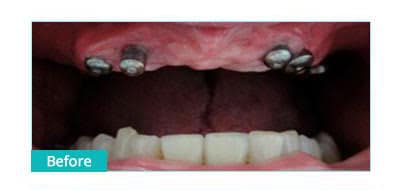Before Image: Implant Bridge - front