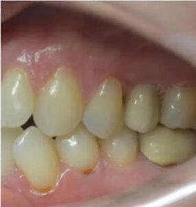 After Image: Implant Bridge