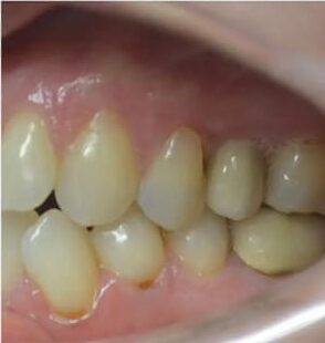 After Image: Implant Bridge - left-side