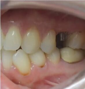 Before Image: Implant Bridge - left-side
